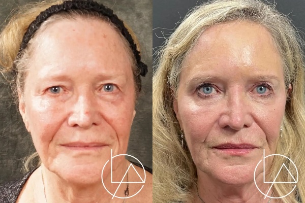blepharoplasty--2016