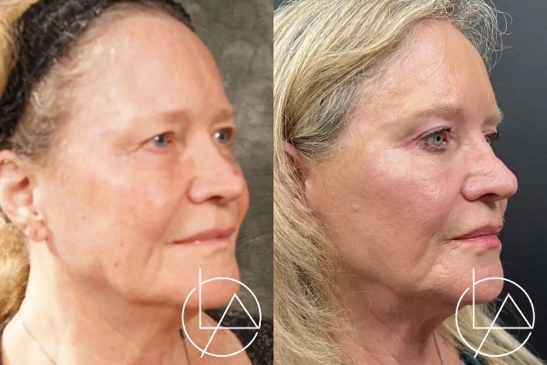 blepharoplasty--2017