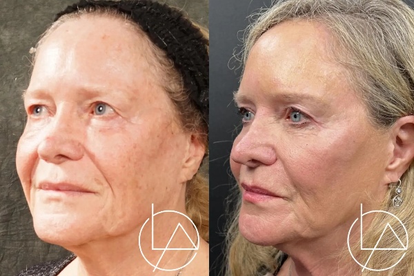 blepharoplasty--2019