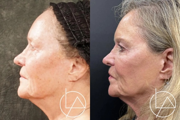 blepharoplasty--2020