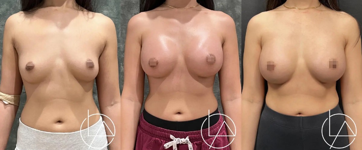 breast-augmentation--2351