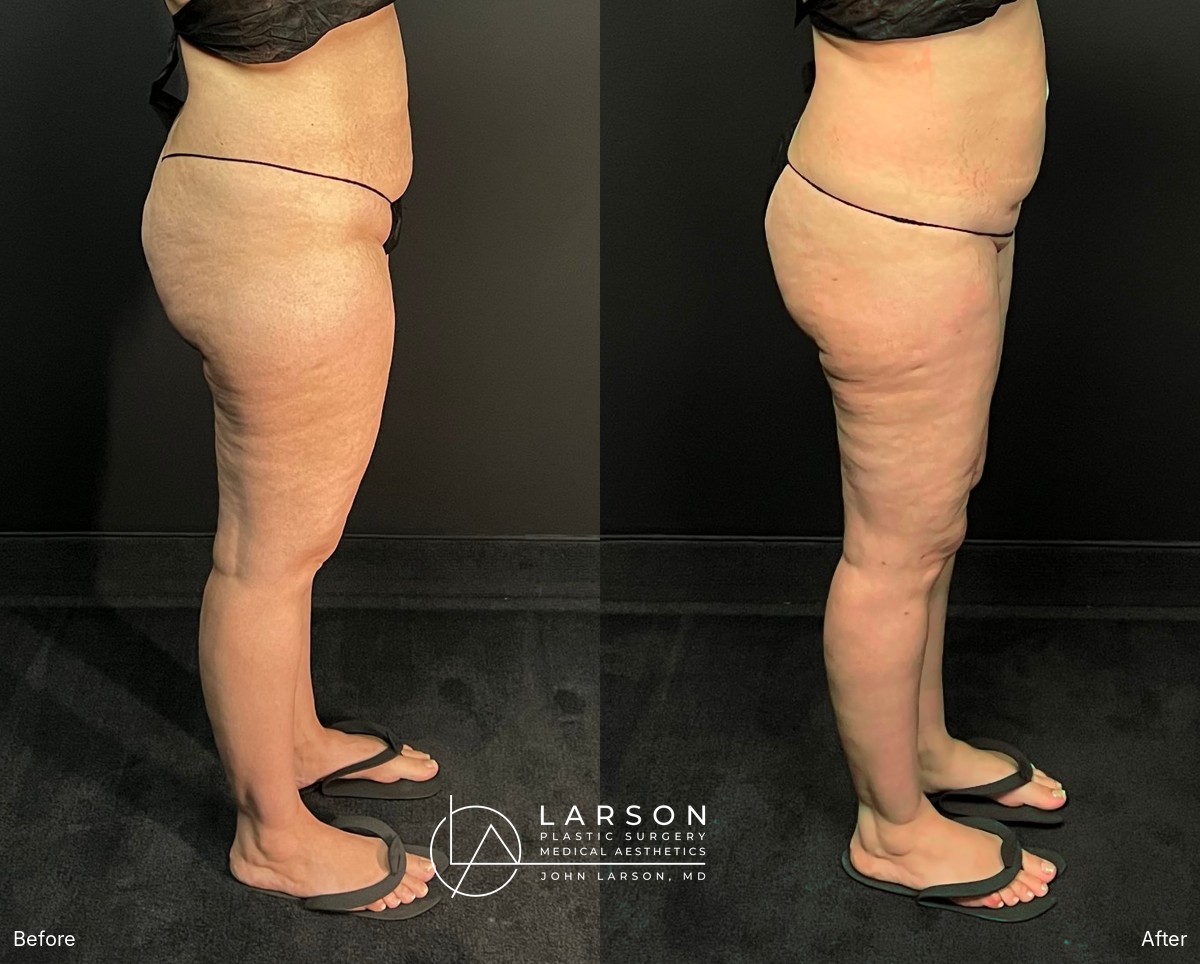 Before and after circumferential full-leg lipedema liposuction with thigh and calf lifts in a 34-year-old woman, 3 months post-op, Newport Beach