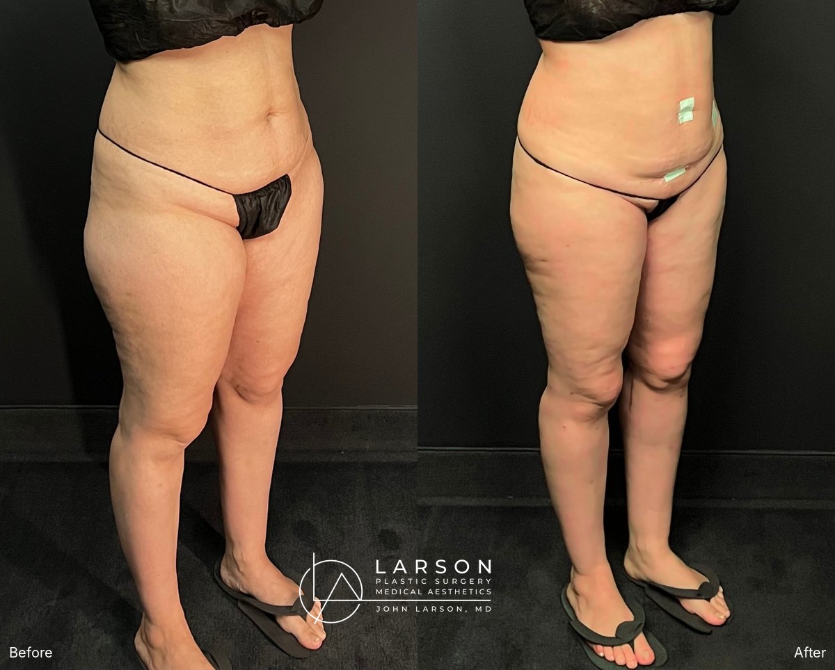 Before and after circumferential full-leg lipedema liposuction with thigh and calf lifts in a 34-year-old woman, 3 months post-op, Newport Beach