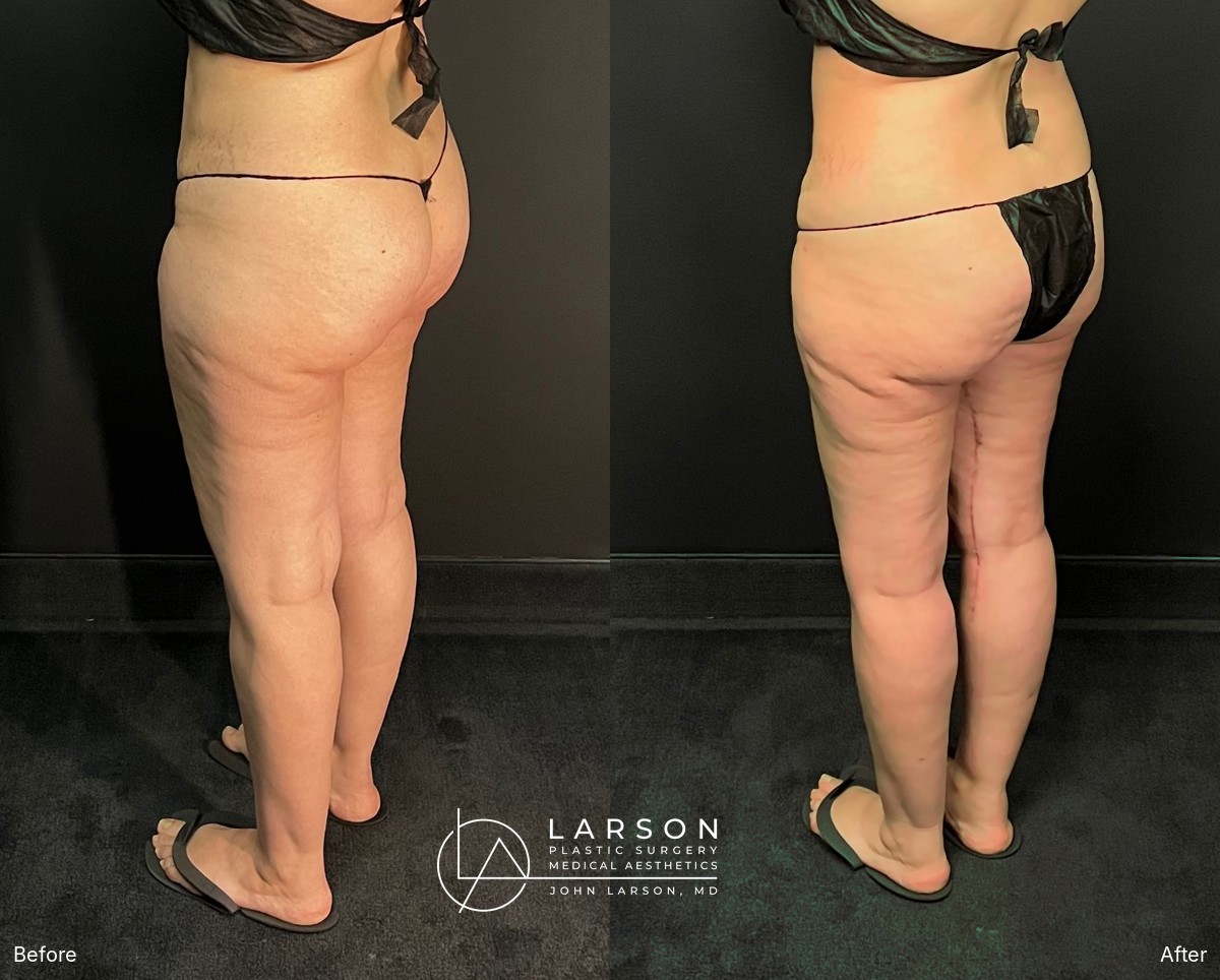 Before and after circumferential full-leg lipedema liposuction with thigh and calf lifts in a 34-year-old woman, 3 months post-op, Newport Beach