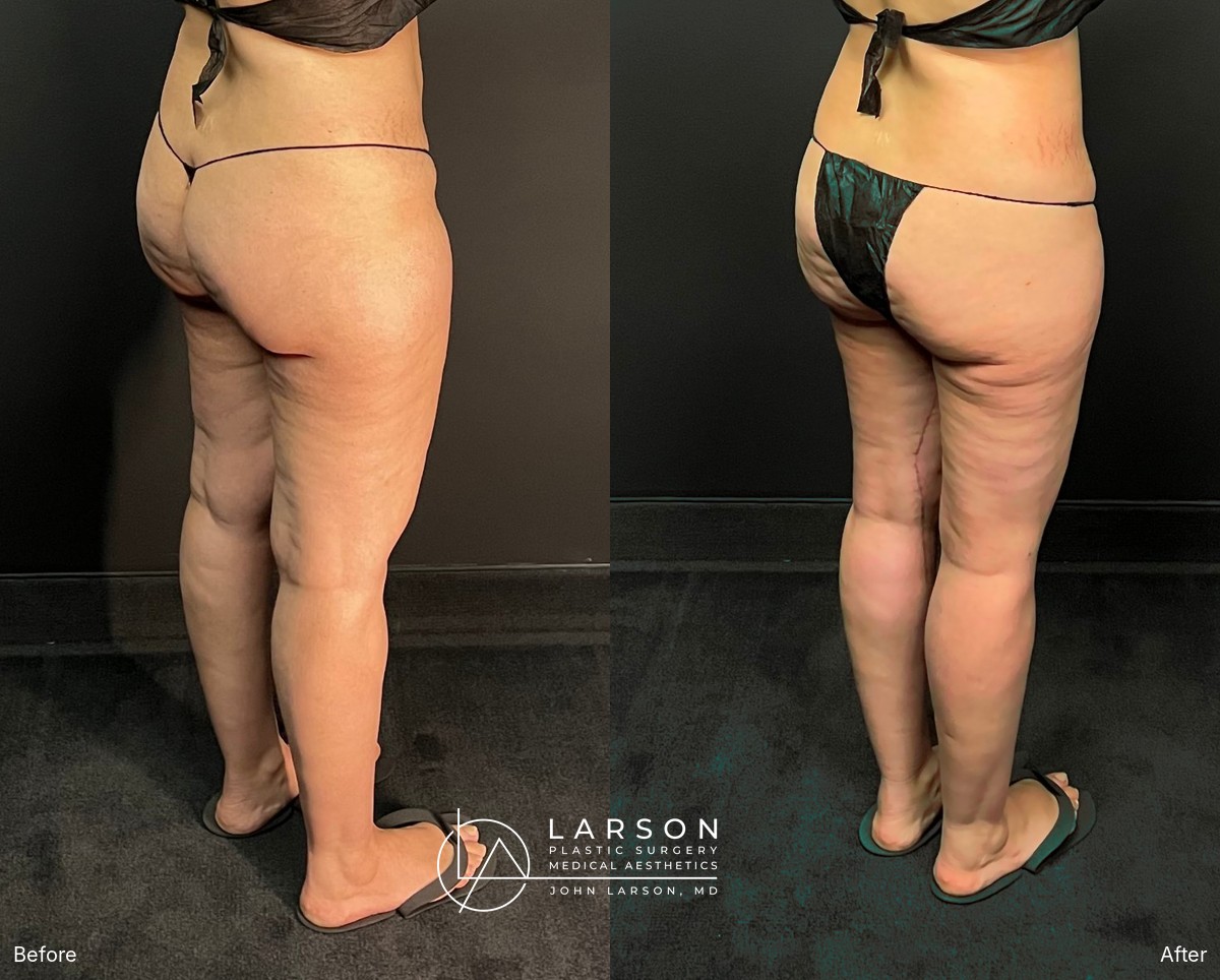 Before and after circumferential full-leg lipedema liposuction with thigh and calf lifts in a 34-year-old woman, 3 months post-op, Newport Beach