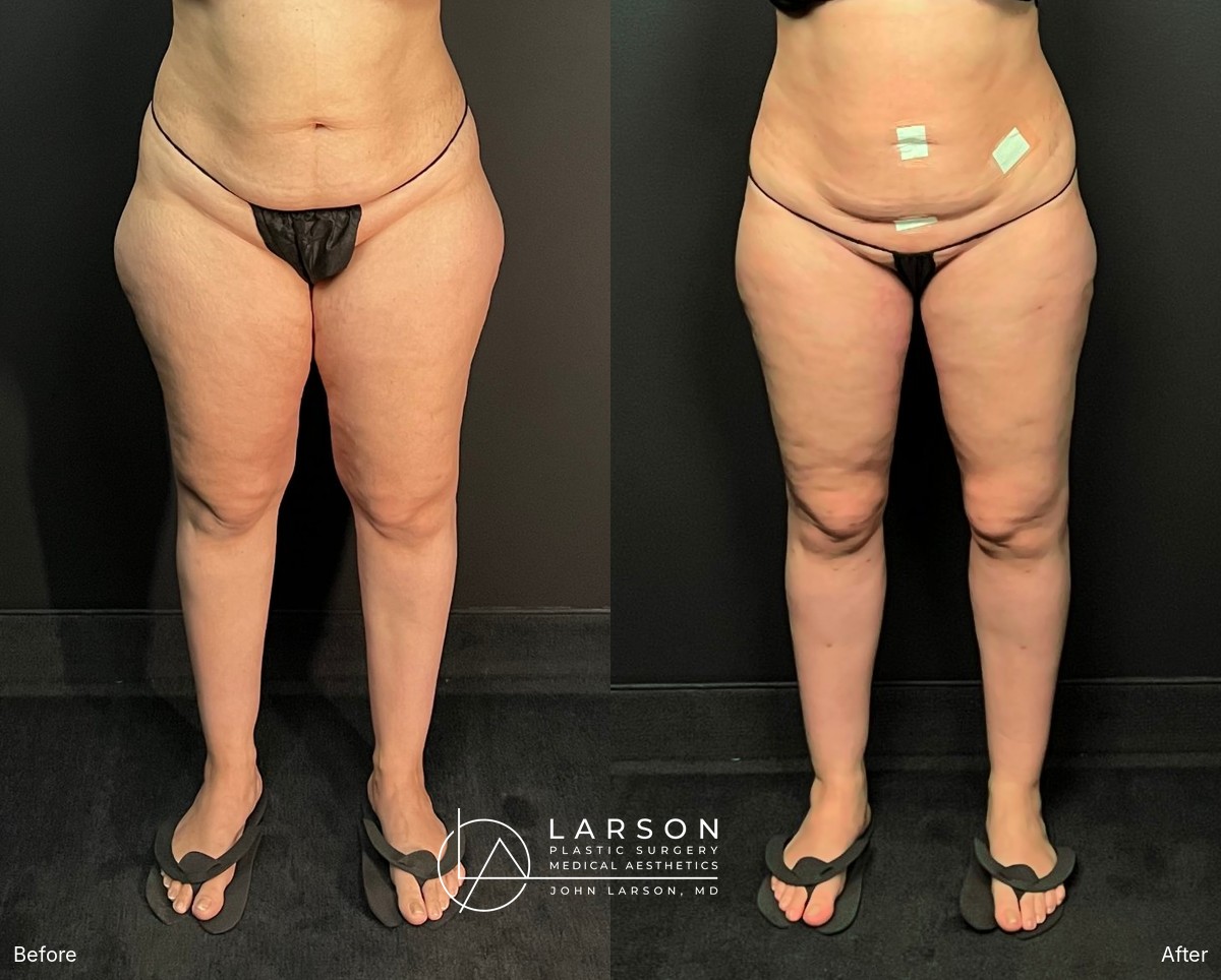Before and after circumferential full-leg lipedema liposuction with thigh and calf lifts in a 34-year-old woman, 3 months post-op, Newport Beach