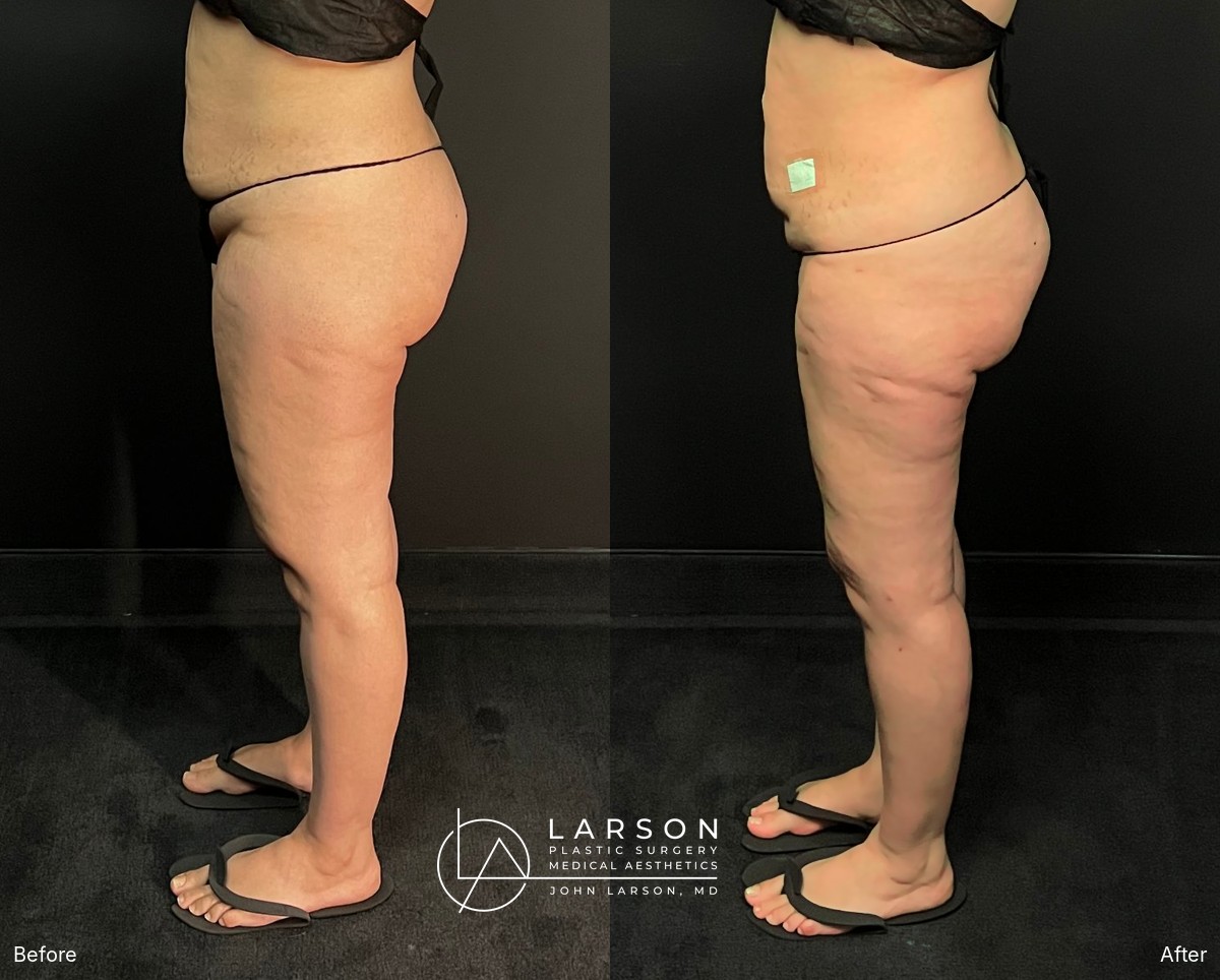 Before and after circumferential full-leg lipedema liposuction with thigh and calf lifts in a 34-year-old woman, 3 months post-op, Newport Beach