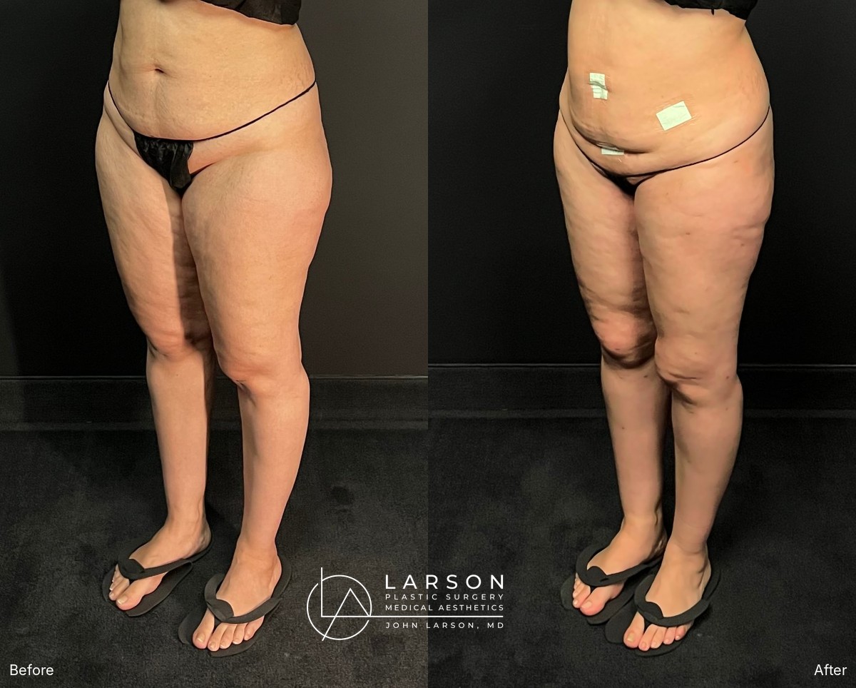 Before and after circumferential full-leg lipedema liposuction with thigh and calf lifts in a 34-year-old woman, 3 months post-op, Newport Beach