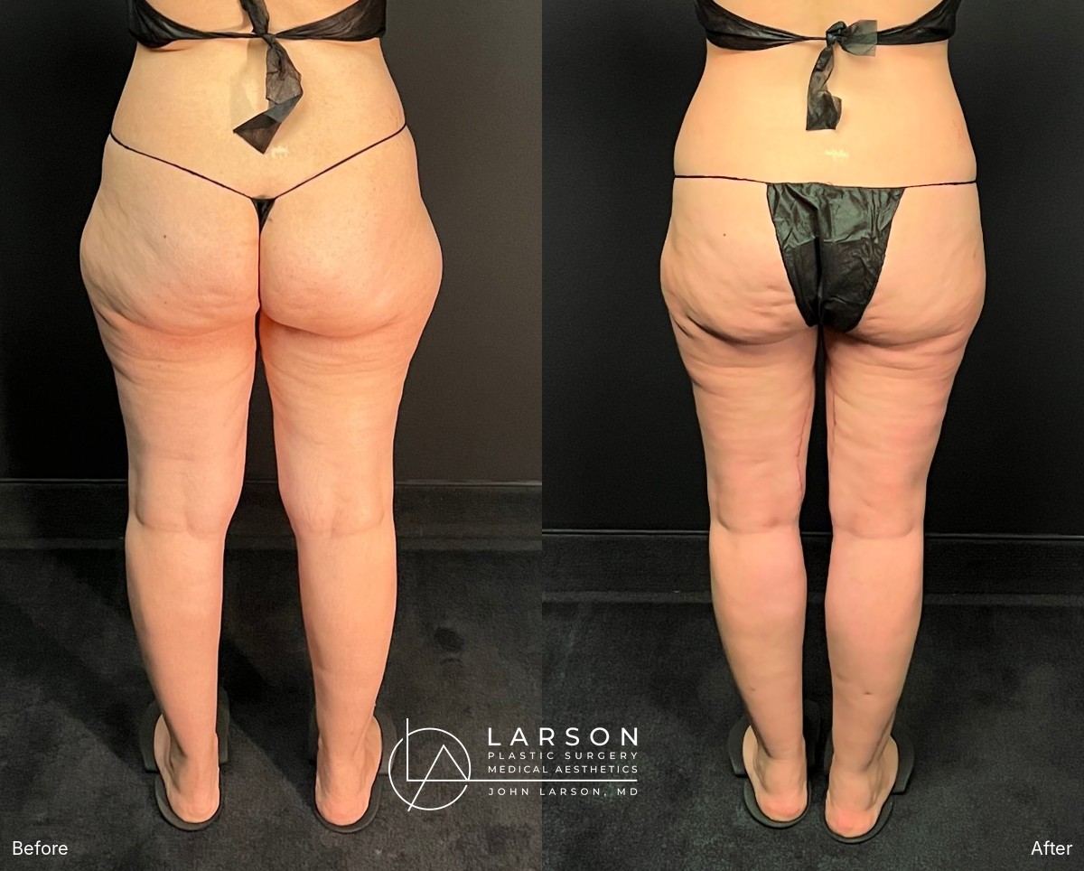 Before and after circumferential full-leg lipedema liposuction with thigh and calf lifts in a 34-year-old woman, 3 months post-op, Newport Beach