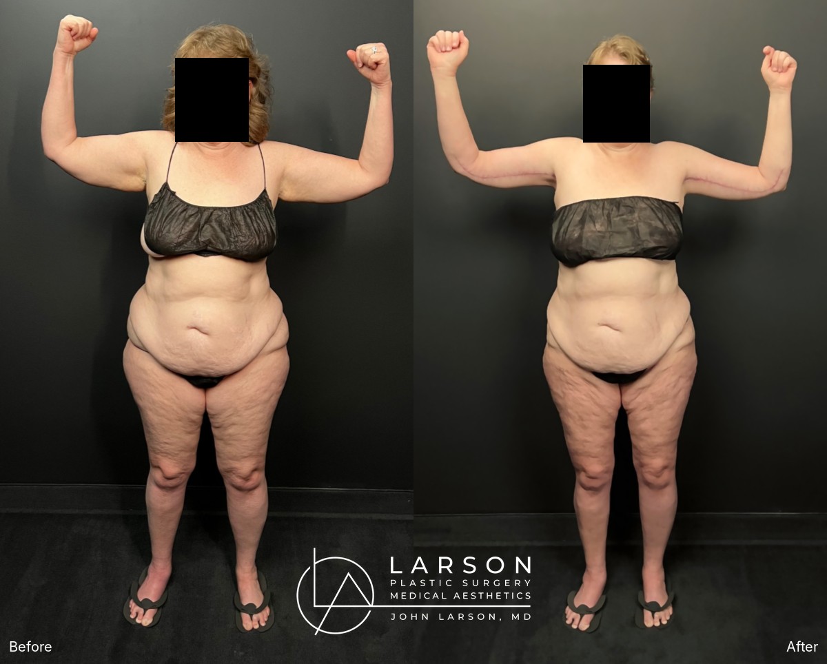 Before and after lipedema arm liposuction with brachioplasty and forearm lift in a 60-year-old woman, Newport Beach