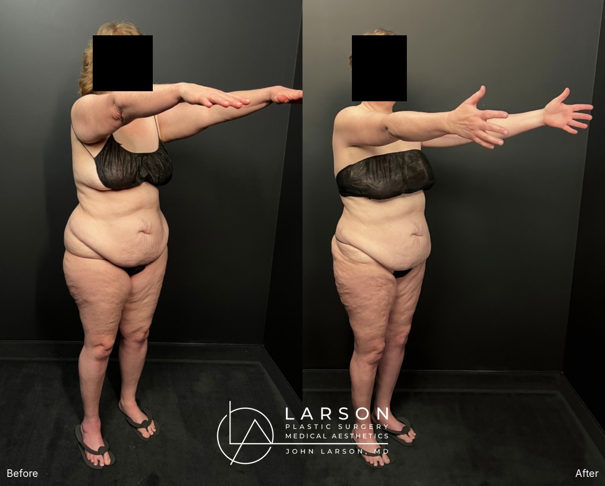 “Before and after first-stage full-leg and hip lipedema liposuction in a 60-year-old woman, Newport Beach”