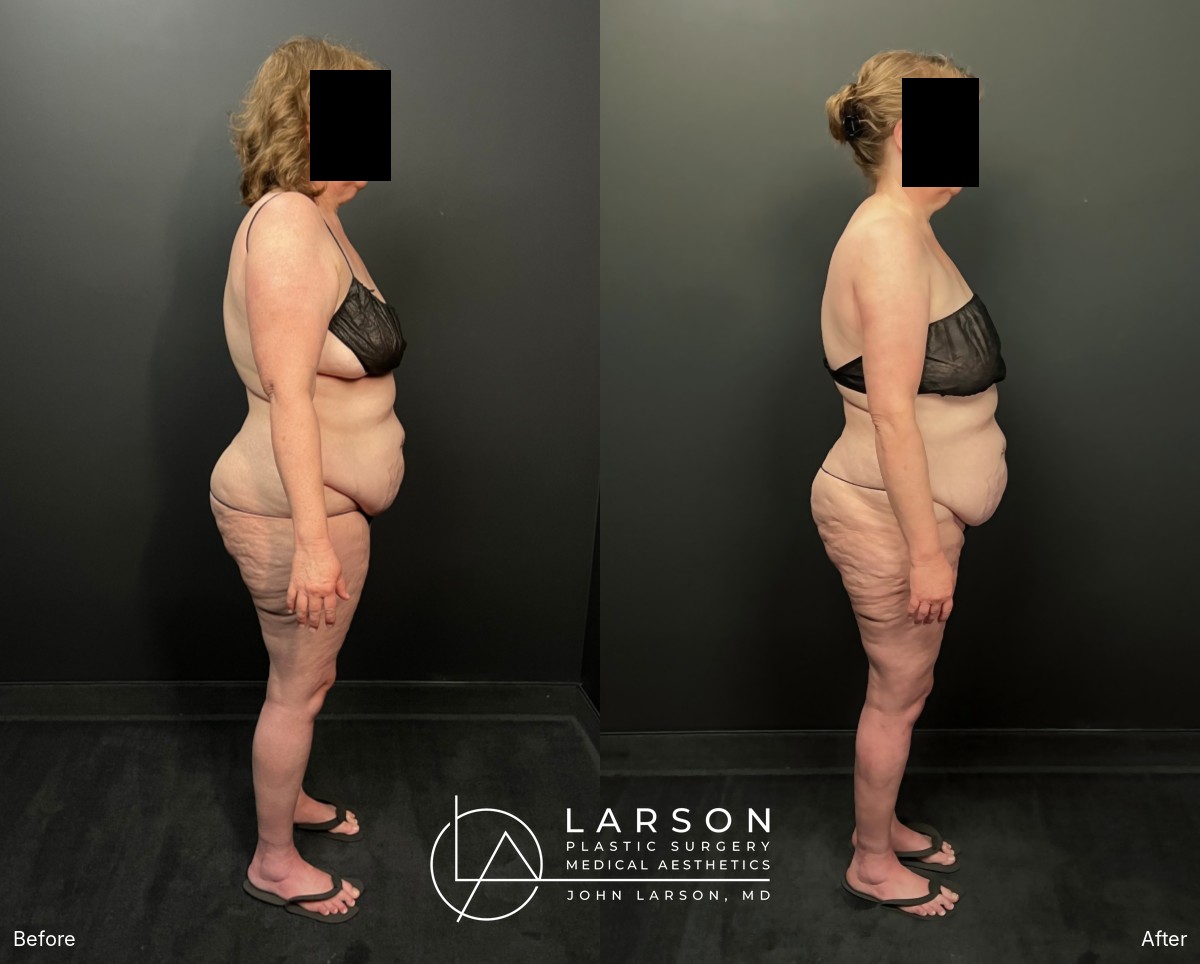 Before and after first-stage full-leg and hip lipedema liposuction in a 60-year-old woman, Newport Beach