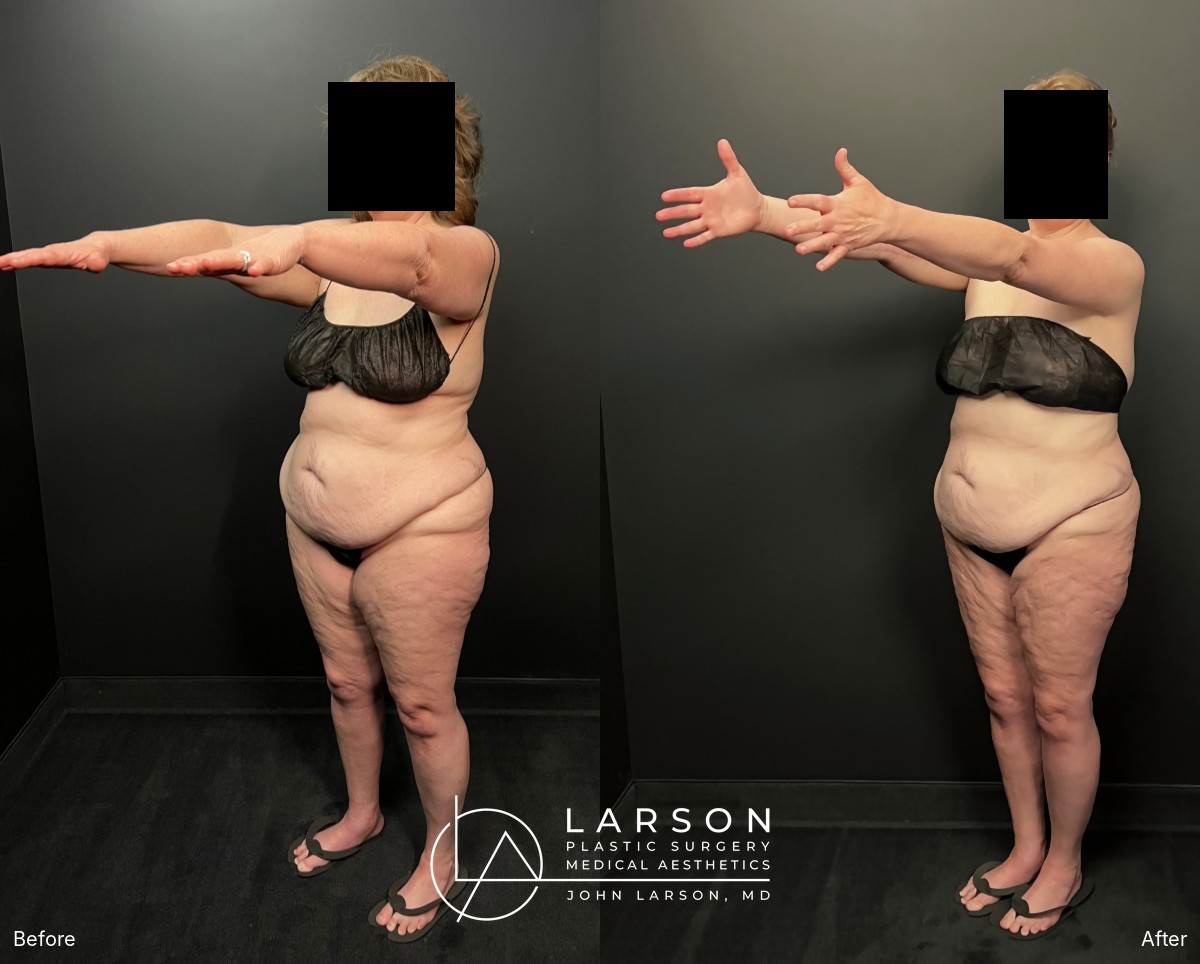 Before and after first-stage full-leg and hip lipedema liposuction in a 60-year-old woman, Newport Beach