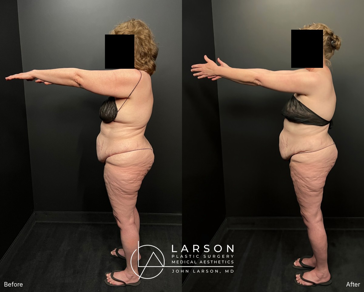 Before and after first-stage full-leg and hip lipedema liposuction in a 60-year-old woman, Newport Beach
