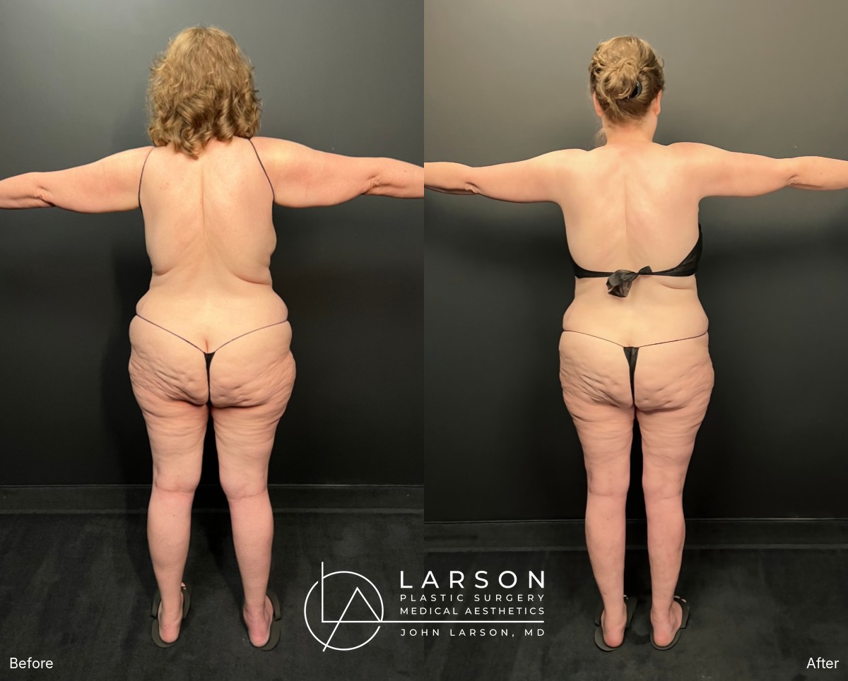 Before and after lipedema arm liposuction with brachioplasty and forearm lift in a 60-year-old woman, Newport Beach