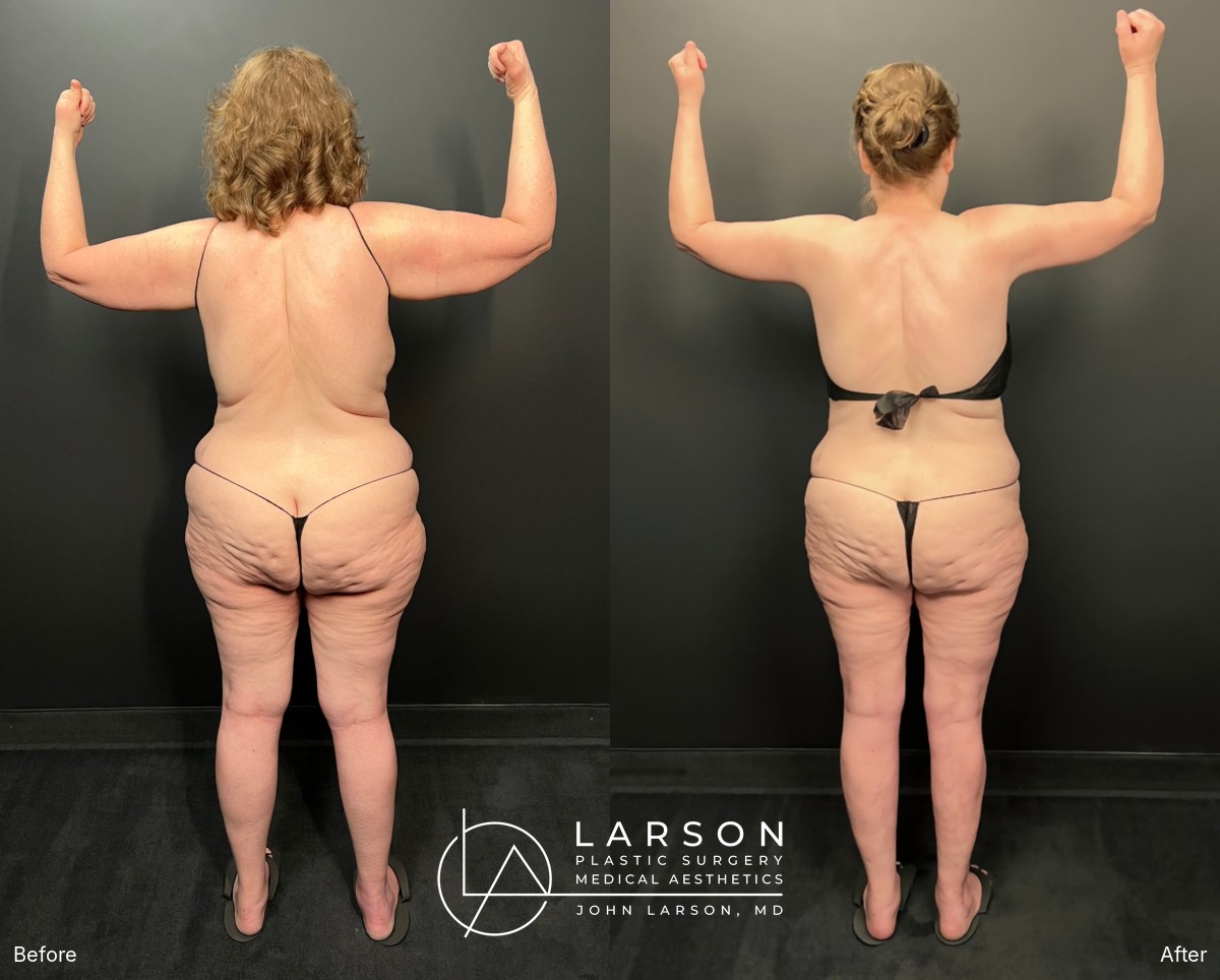 Before and after lipedema arm liposuction with brachioplasty and forearm lift in a 60-year-old woman, Newport Beach