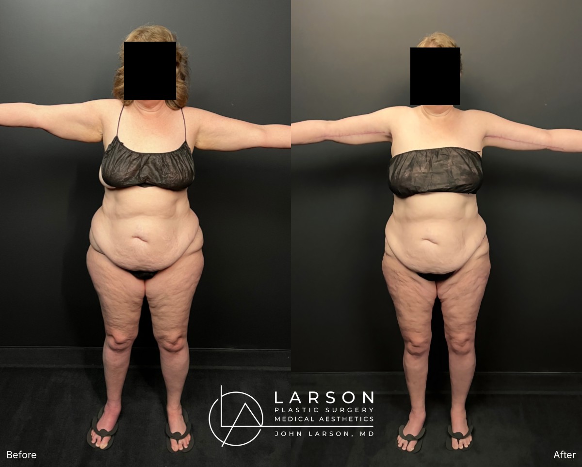 “Before and after lipedema arm liposuction with brachioplasty and forearm lift in a 60-year-old woman, Newport Beach”