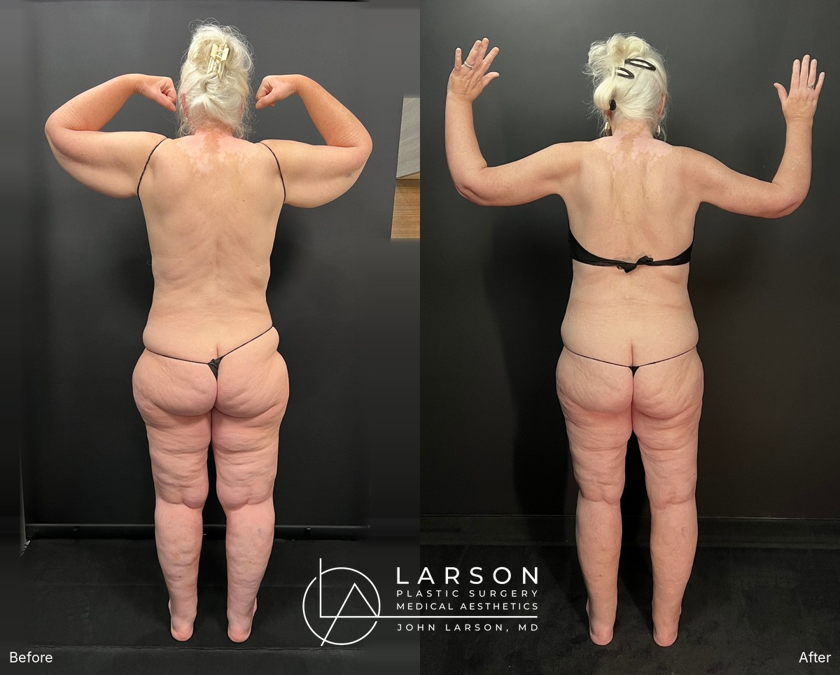 “Before and after lipedema arm liposuction with extended brachioplasty in a 64-year-old woman, Newport Beach”