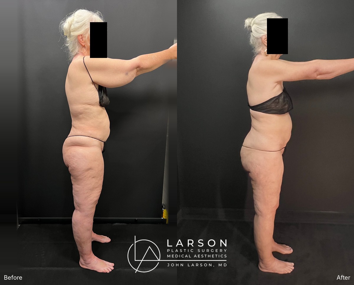Before and after full-leg circumferential lipedema liposuction in a 64-year-old woman, showing improved leg symmetry, Newport Beach