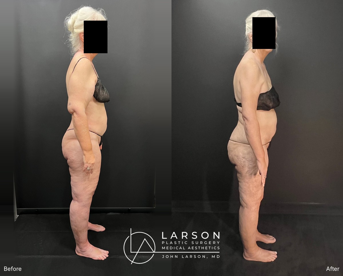 “Before and after full-leg circumferential lipedema liposuction in a 64-year-old woman, showing improved leg symmetry, Newport Beach”