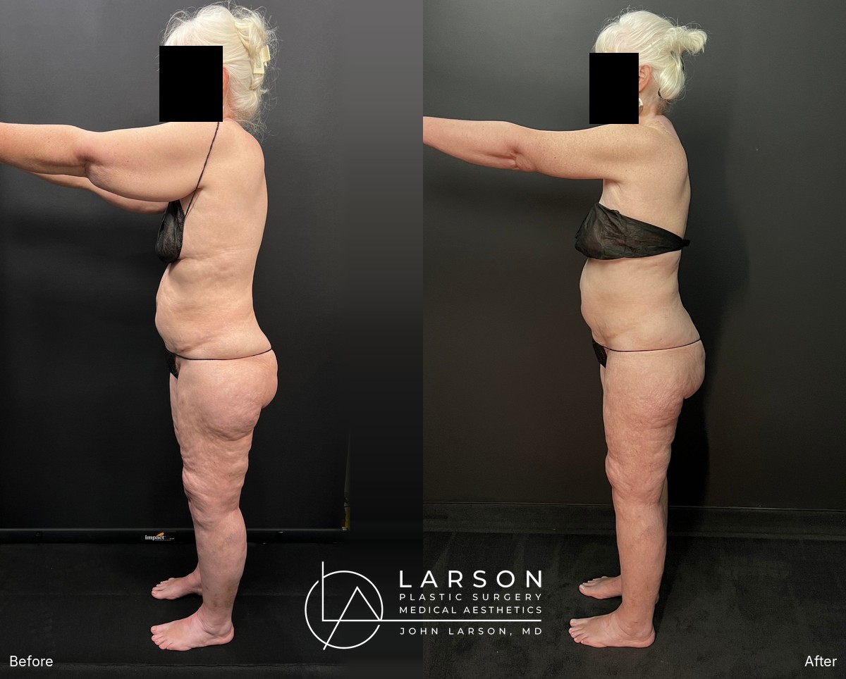 “Before and after full-leg circumferential lipedema liposuction in a 64-year-old woman, showing improved leg symmetry, Newport Beach”
