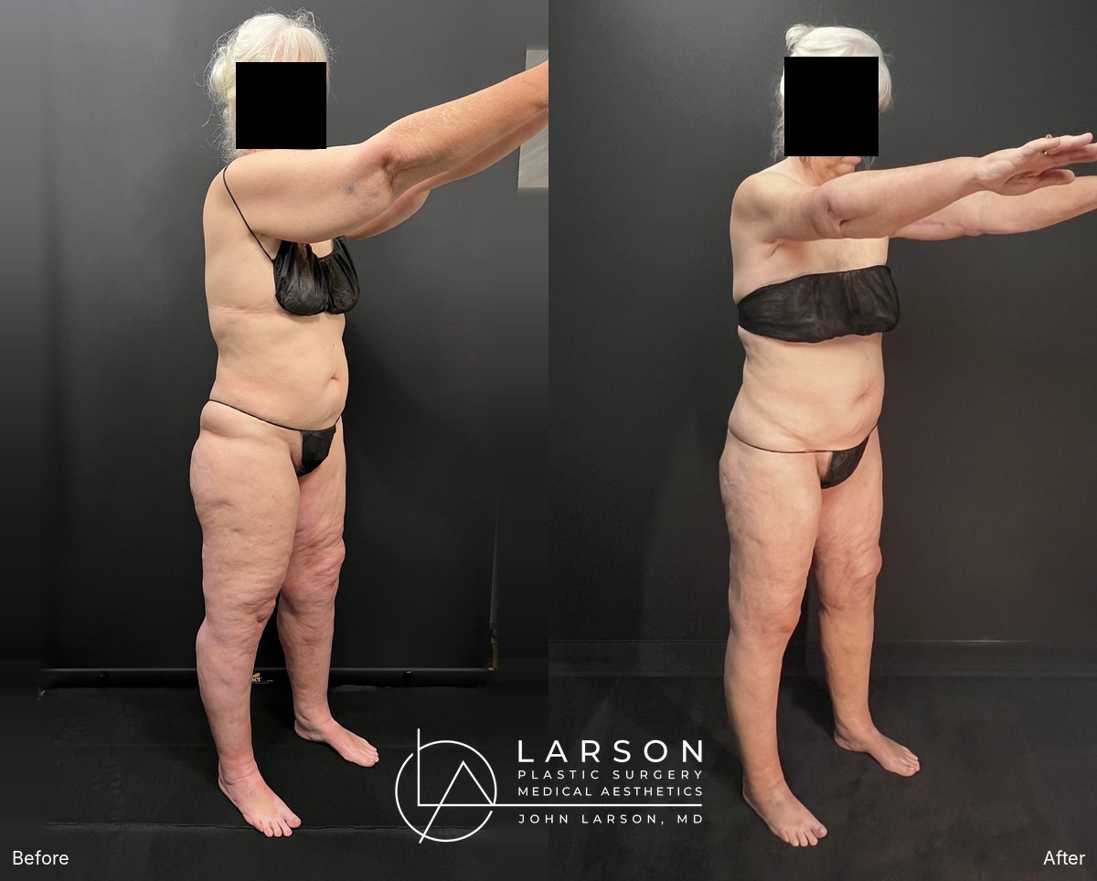 Before and after full-leg circumferential lipedema liposuction in a 64-year-old woman, showing improved leg symmetry, Newport Beach