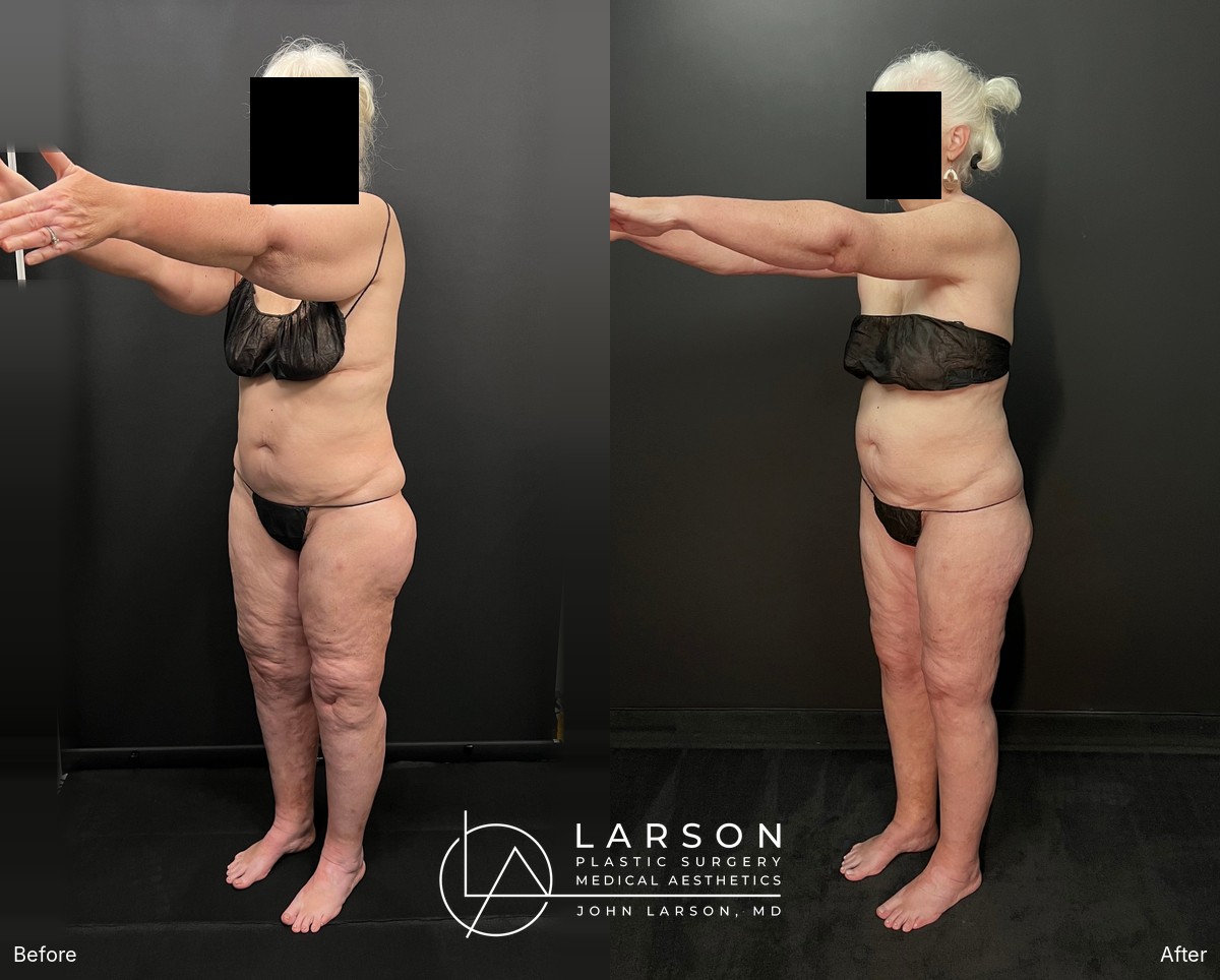 “Before and after lipedema arm liposuction with extended brachioplasty in a 64-year-old woman, Newport Beach”