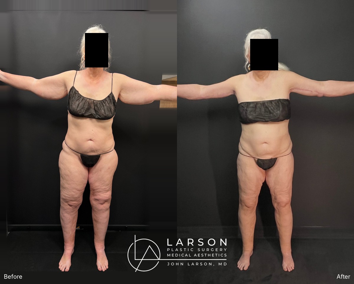 Before and after lipedema arm liposuction with extended brachioplasty in a 64-year-old woman, Newport Beach