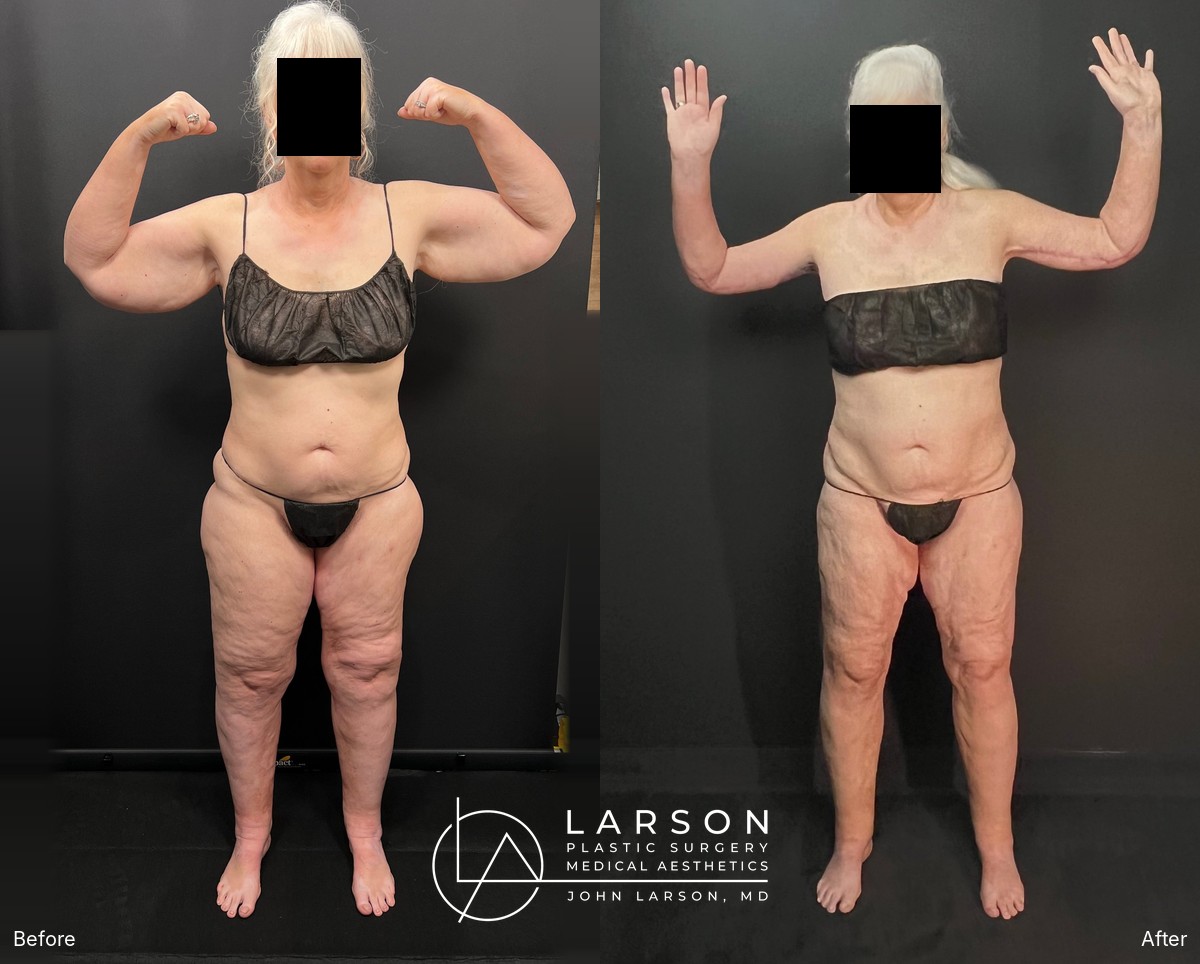 “Before and after lipedema arm liposuction with extended brachioplasty in a 64-year-old woman, Newport Beach”