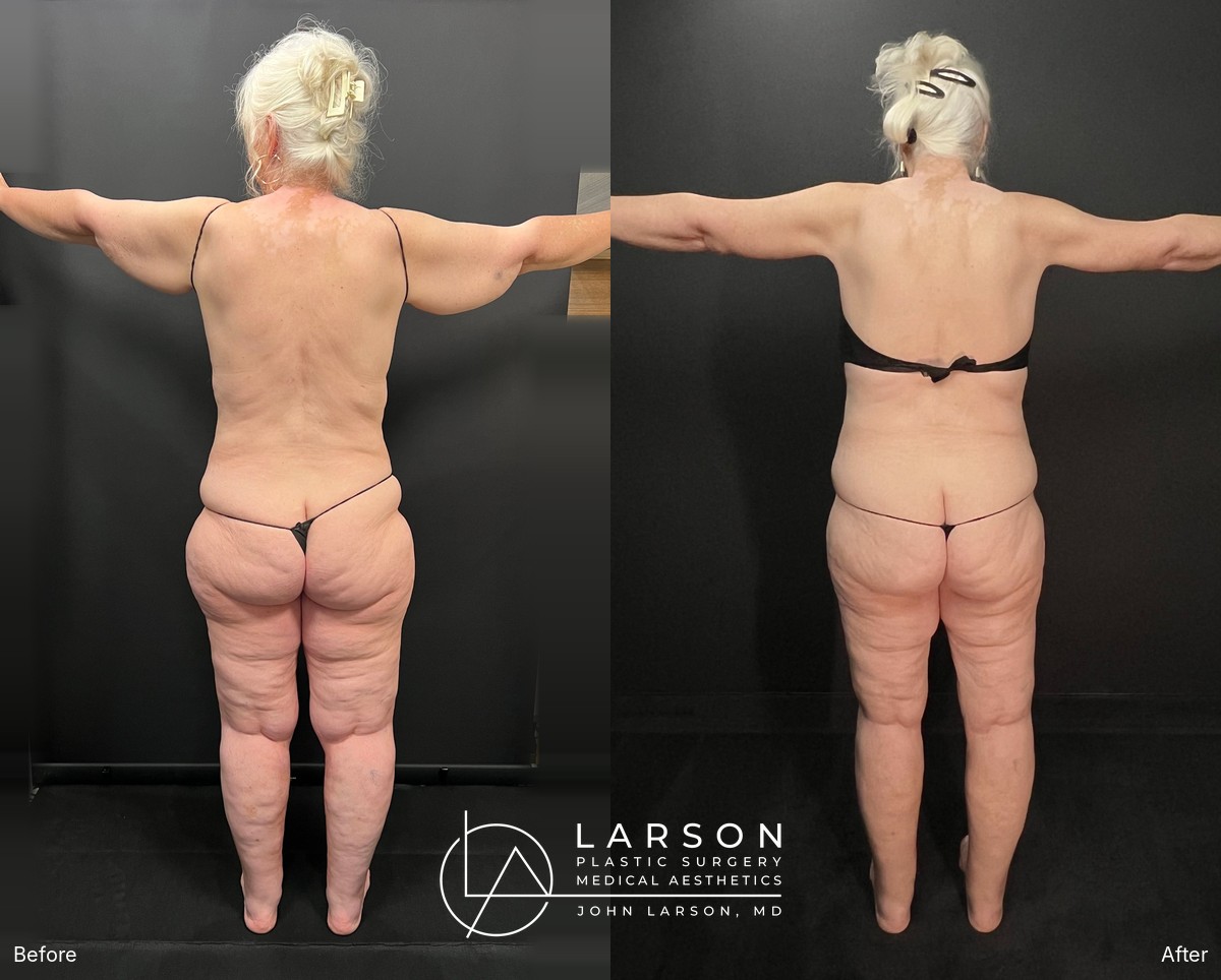 “Before and after lipedema arm liposuction with extended brachioplasty in a 64-year-old woman, Newport Beach”