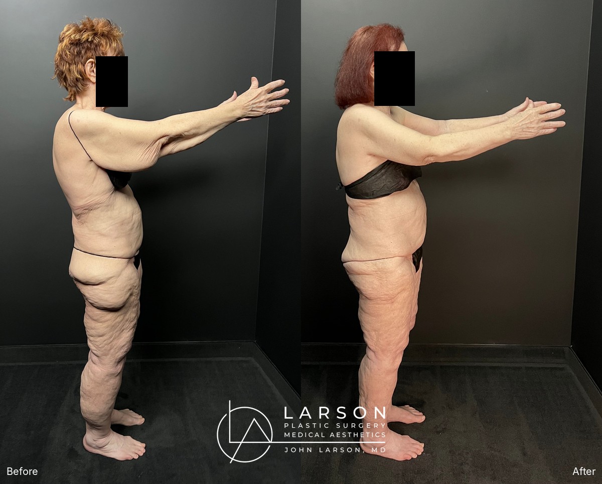 Before and after first-stage full-leg and hip lipedema liposuction in a 76-year-old woman, Newport Beach