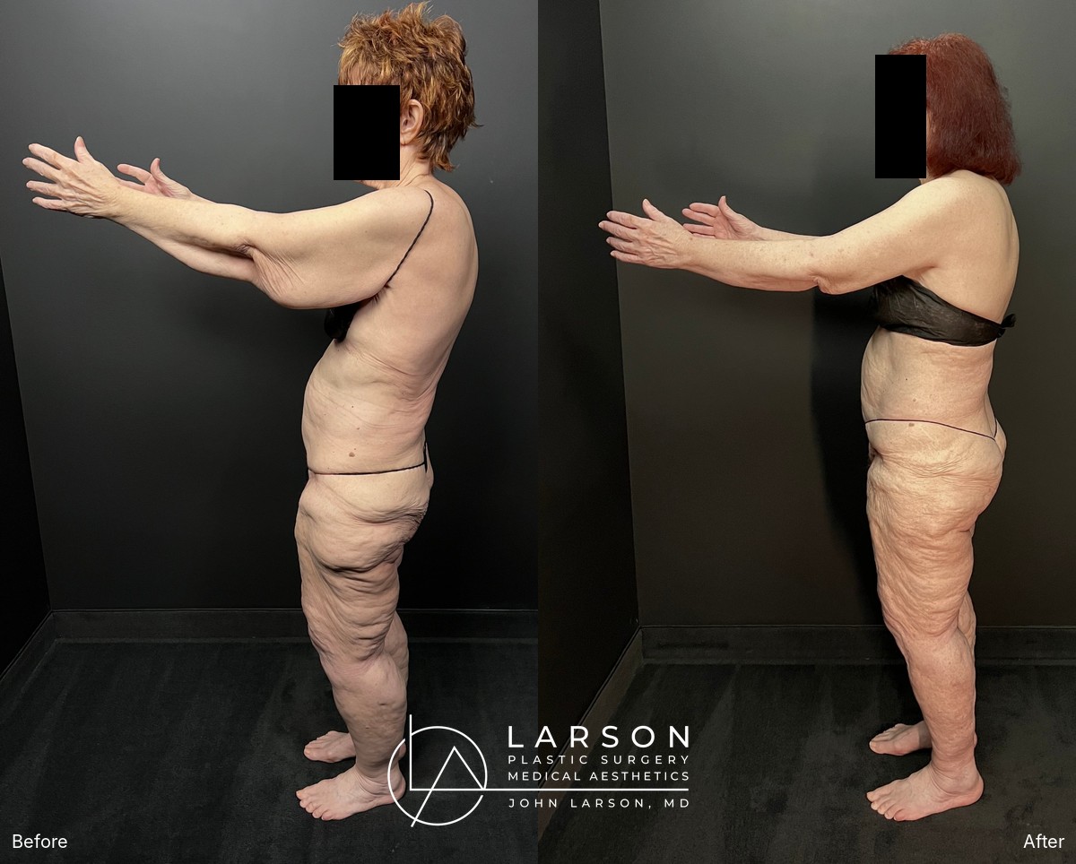 “Before and after first-stage full-leg and hip lipedema liposuction in a 76-year-old woman, Newport Beach”