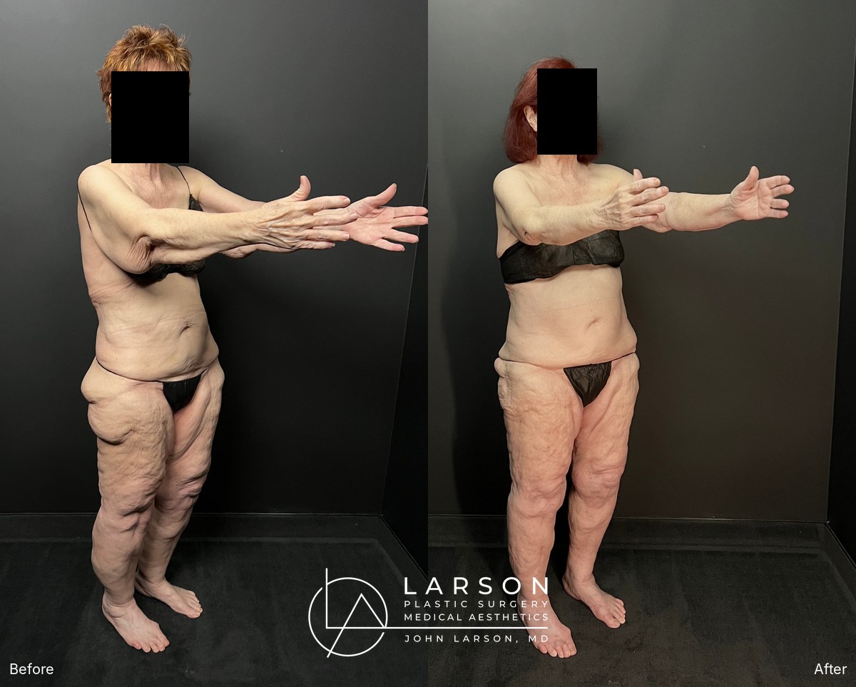 Before and after first-stage full-leg and hip lipedema liposuction in a 76-year-old woman, Newport Beach