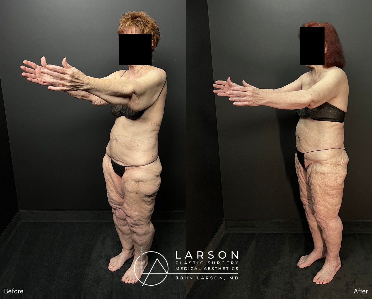 Before and after first-stage full-leg and hip lipedema liposuction in a 76-year-old woman, Newport Beach