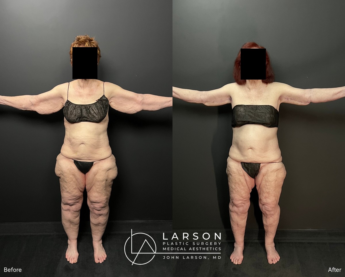 “Before and after lipedema arm liposuction with brachioplasty and forearm lift in a 76-year-old woman, Newport Beach”