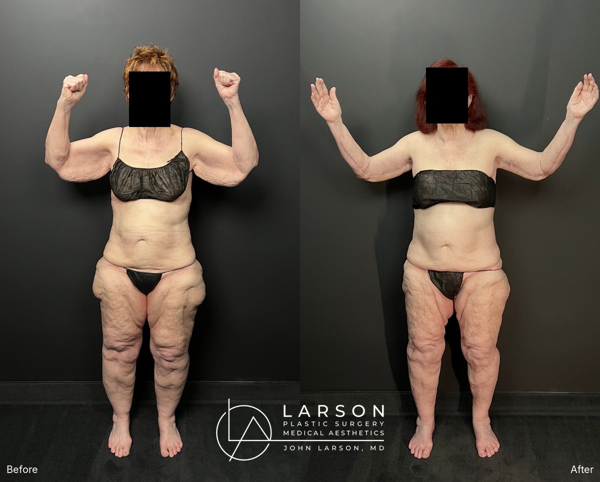 “Before and after lipedema arm liposuction with brachioplasty and forearm lift in a 76-year-old woman, Newport Beach”
