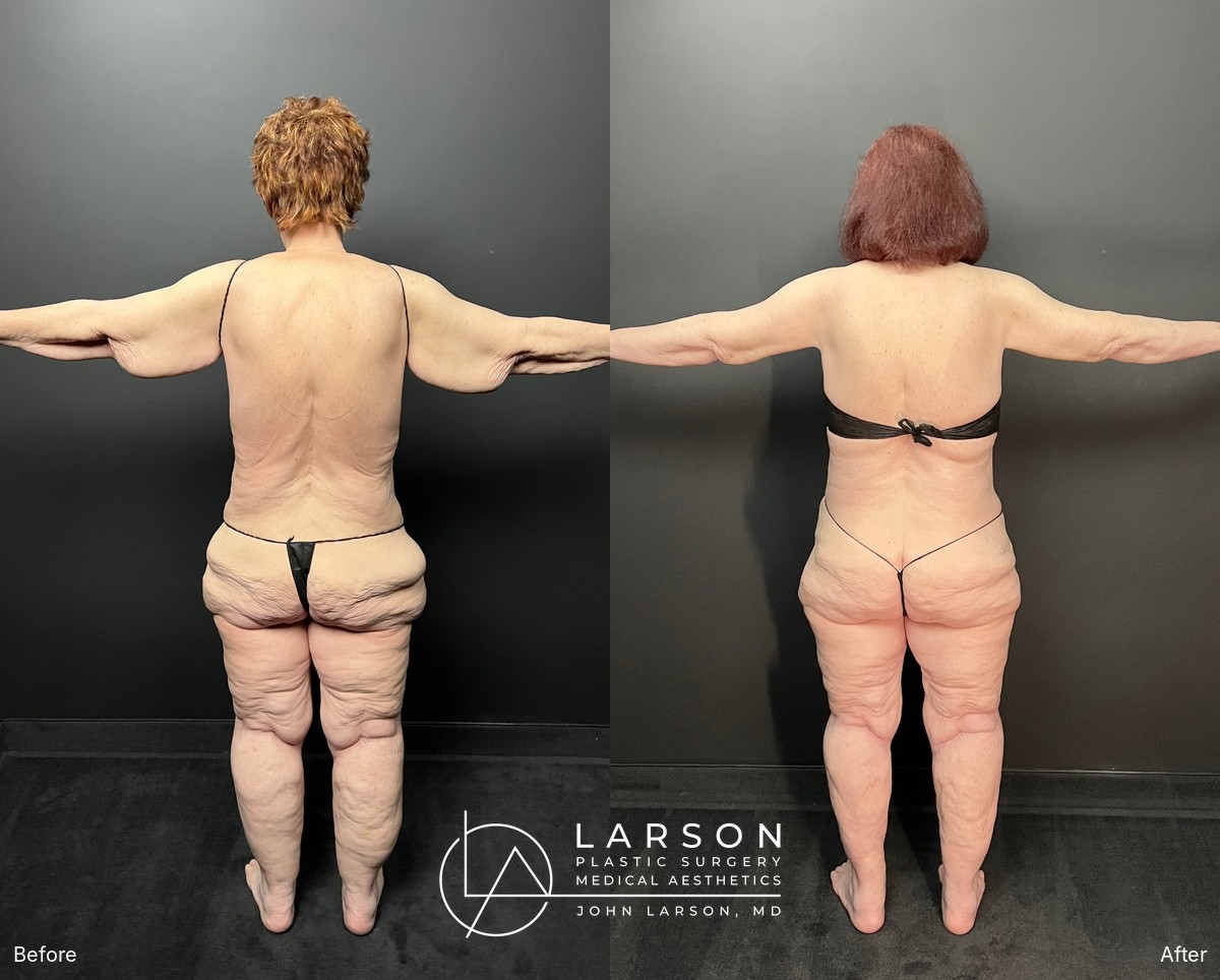 “Before and after first-stage full-leg and hip lipedema liposuction in a 76-year-old woman, Newport Beach”