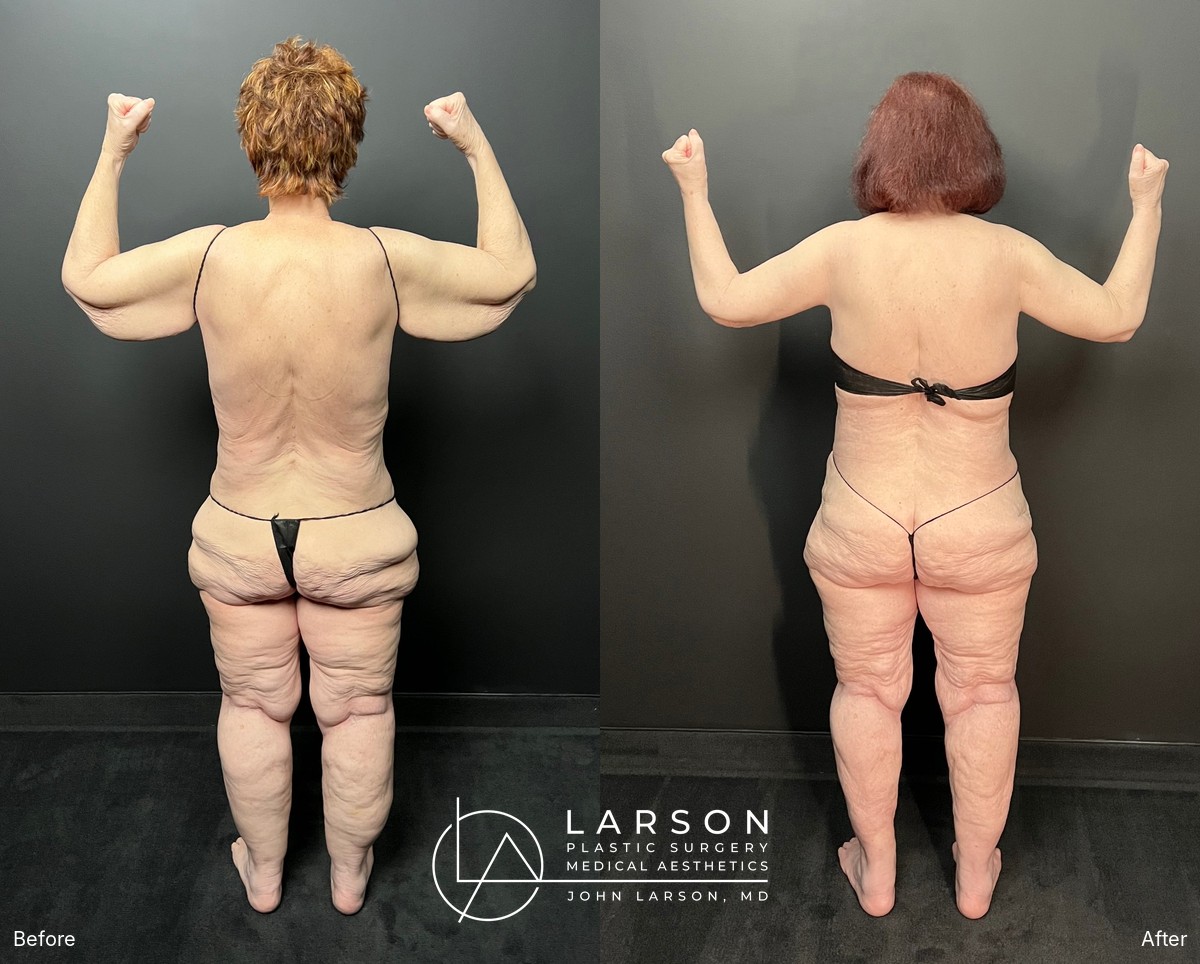 “Before and after first-stage full-leg and hip lipedema liposuction in a 76-year-old woman, Newport Beach”