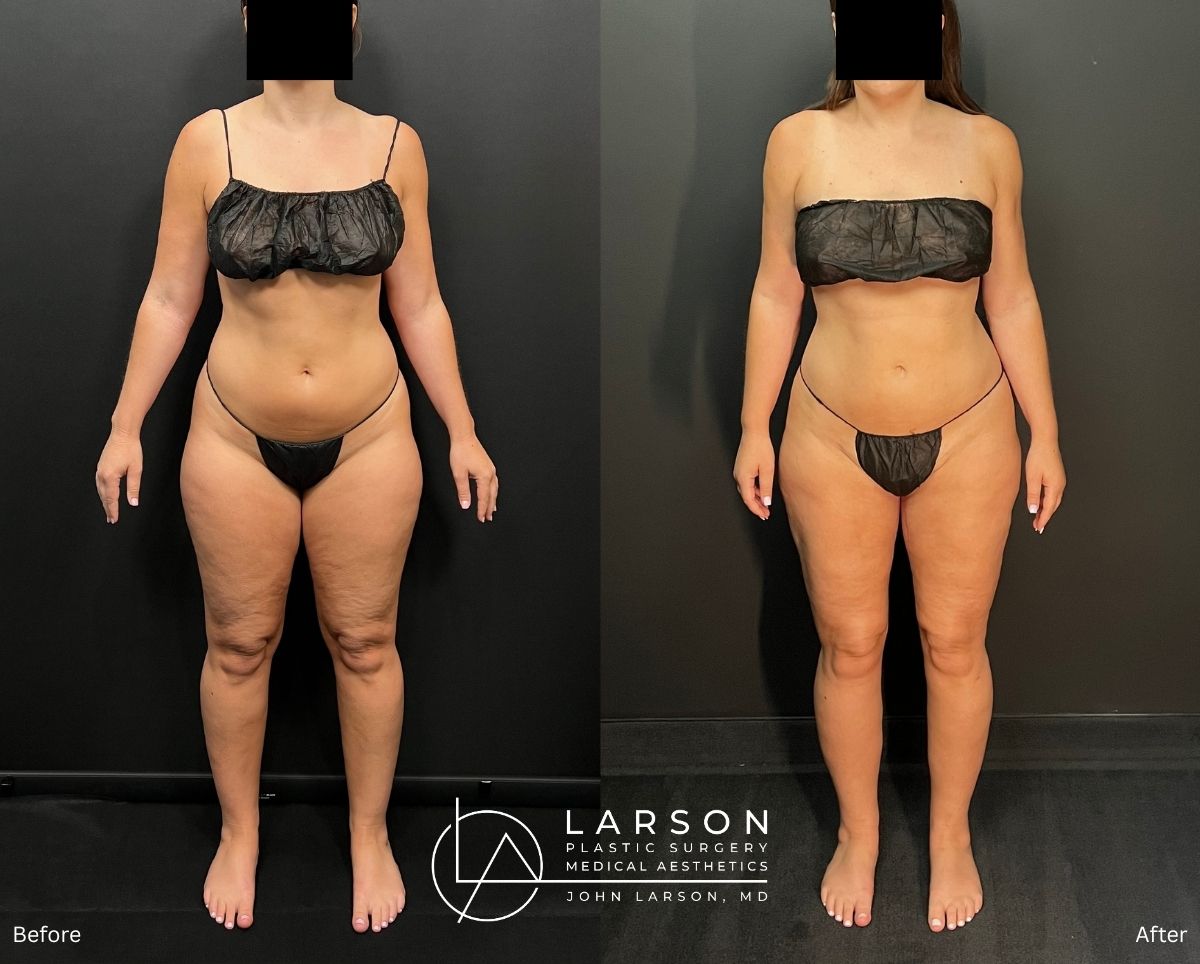 Before and after three-stage lipedema surgery in a 37-year-old woman, showing full-leg and hip liposuction with thigh and calf lifts, 3 months post-op, Newport Beach