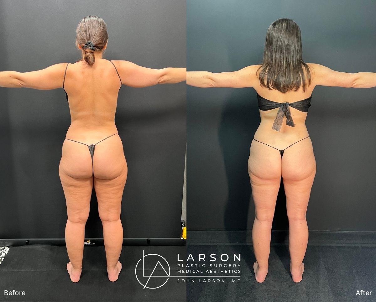“Before and after lipedema arm liposuction with brachioplasty in a 37-year-old woman, Newport Beach”