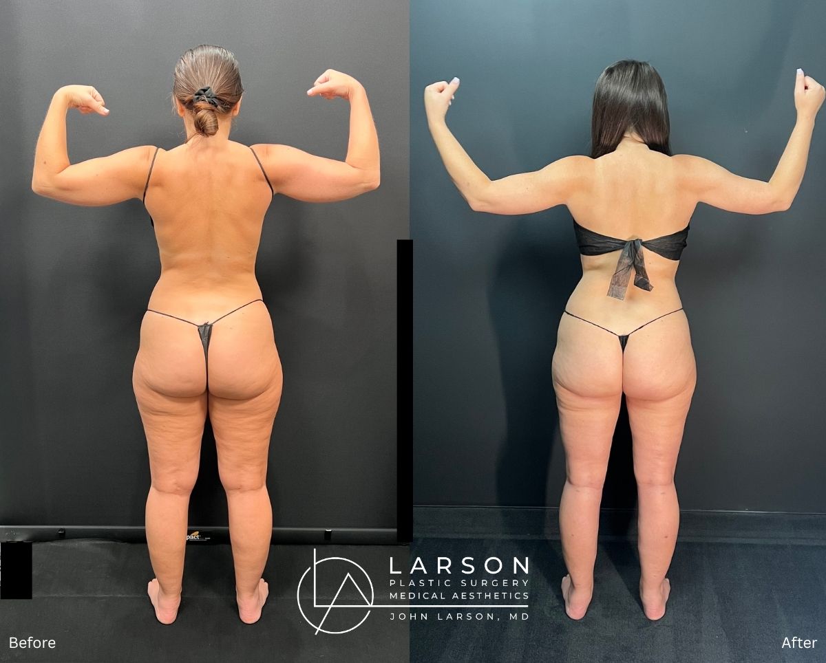 “Before and after lipedema arm liposuction with brachioplasty in a 37-year-old woman, Newport Beach”