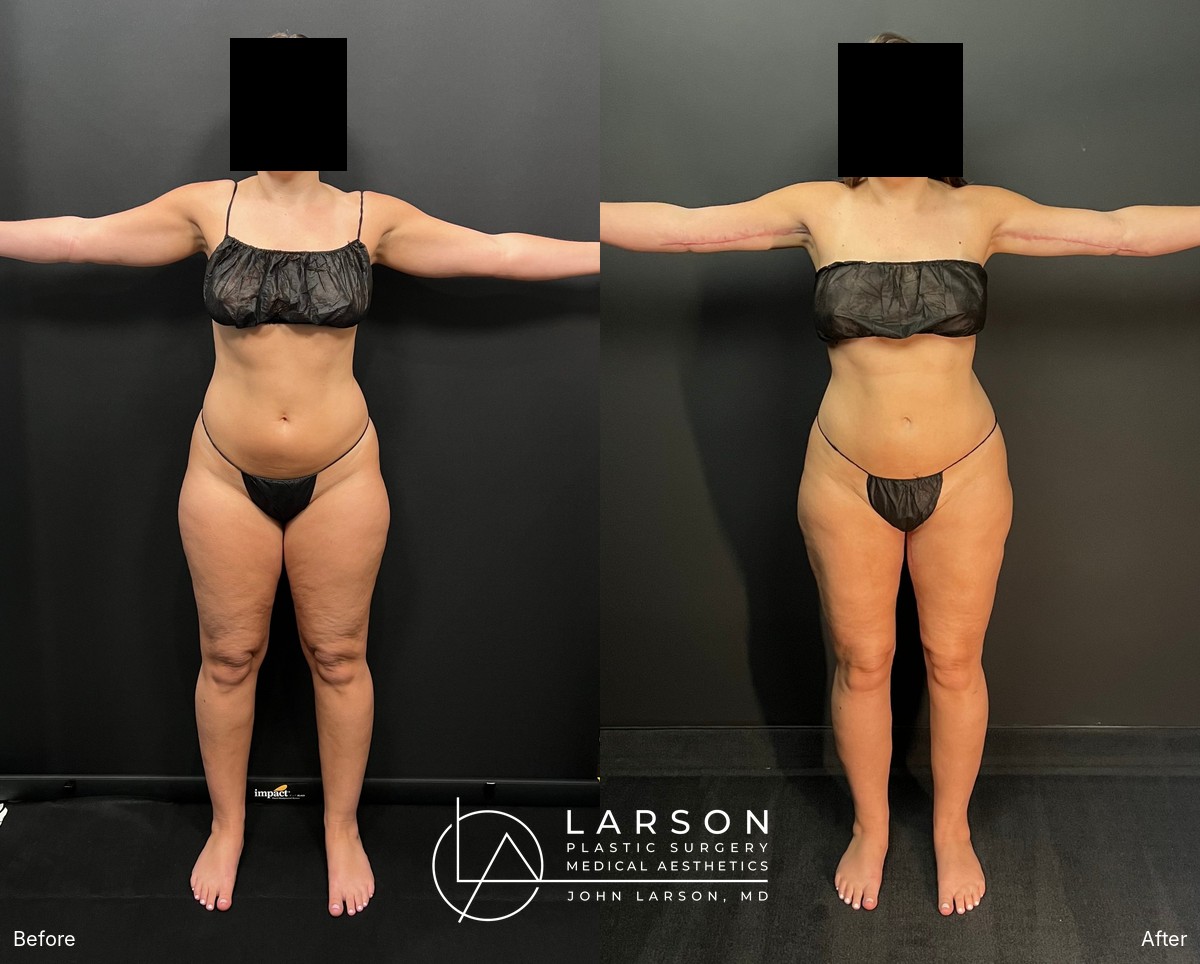 “Before and after lipedema arm liposuction with brachioplasty in a 37-year-old woman, Newport Beach”