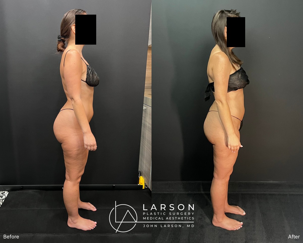 “Before and after three-stage lipedema surgery in a 37-year-old woman, showing full-leg and hip liposuction with thigh and calf lifts, 3 months post-op, Newport Beach”