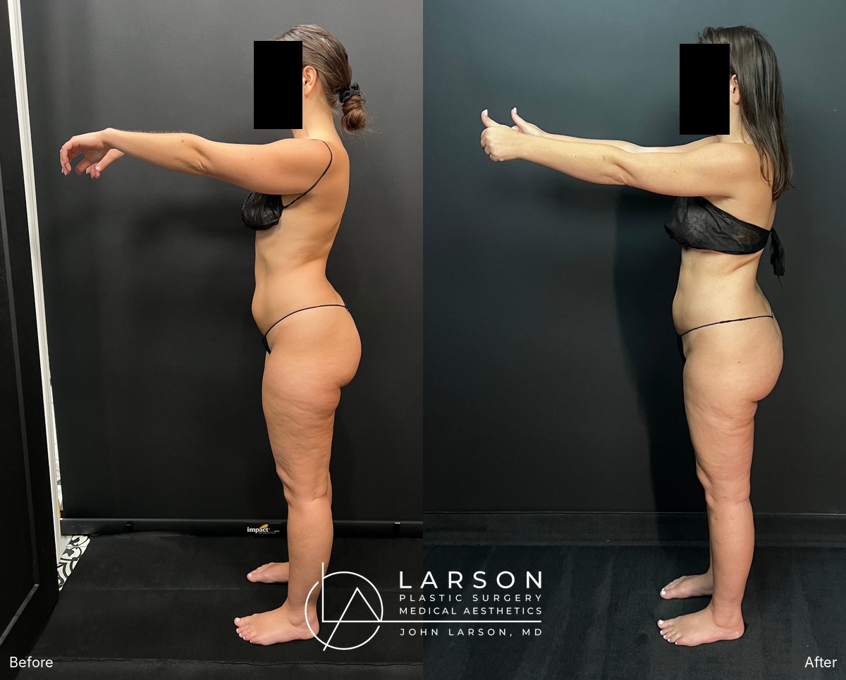 Before and after lipedema arm liposuction with brachioplasty in a 37-year-old woman, Newport Beach
