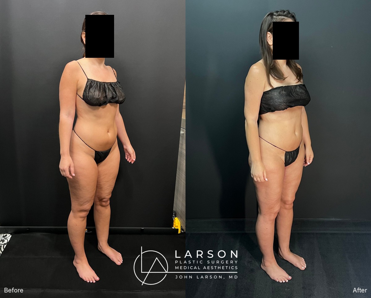 “Before and after three-stage lipedema surgery in a 37-year-old woman, showing full-leg and hip liposuction with thigh and calf lifts, 3 months post-op, Newport Beach”