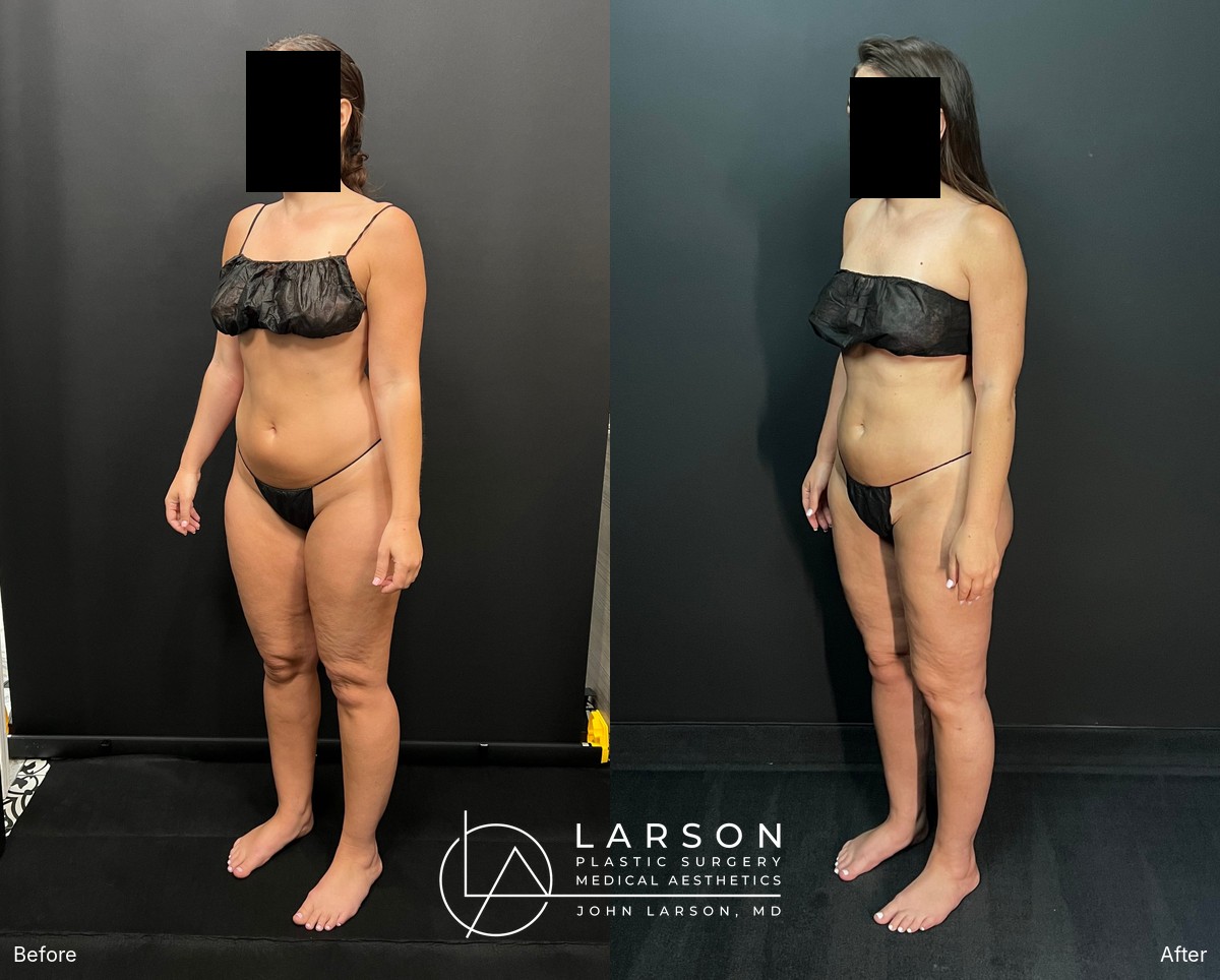 “Before and after three-stage lipedema surgery in a 37-year-old woman, showing full-leg and hip liposuction with thigh and calf lifts, 3 months post-op, Newport Beach”