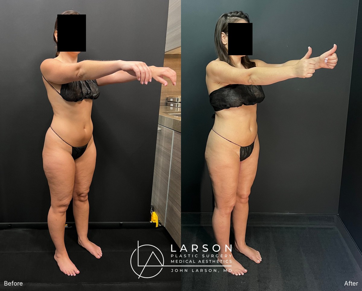“Before and after lipedema arm liposuction with brachioplasty in a 37-year-old woman, Newport Beach”