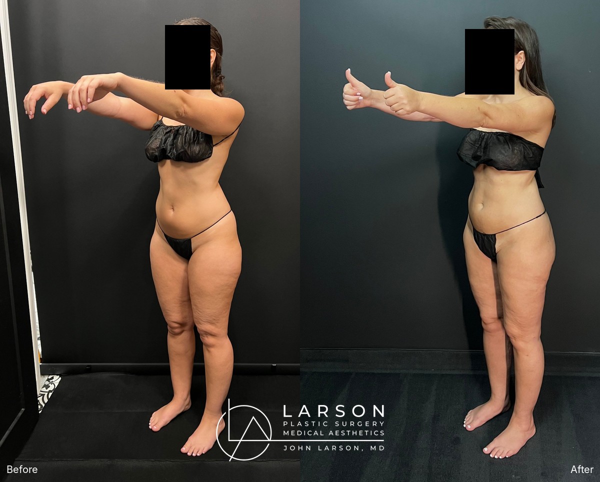 “Before and after lipedema arm liposuction with brachioplasty in a 37-year-old woman, Newport Beach”