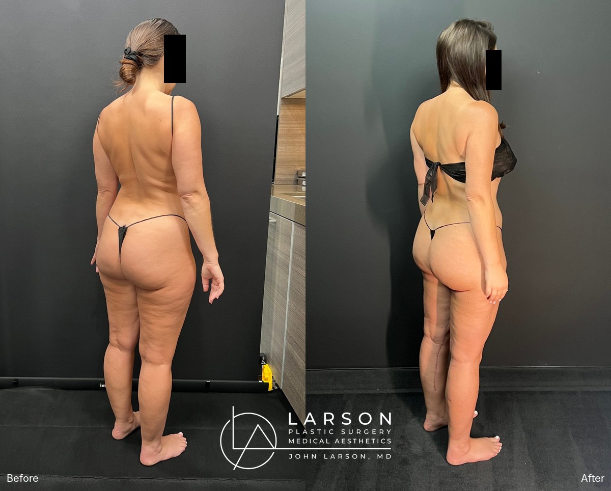 “Before and after three-stage lipedema surgery in a 37-year-old woman, showing full-leg and hip liposuction with thigh and calf lifts, 3 months post-op, Newport Beach”