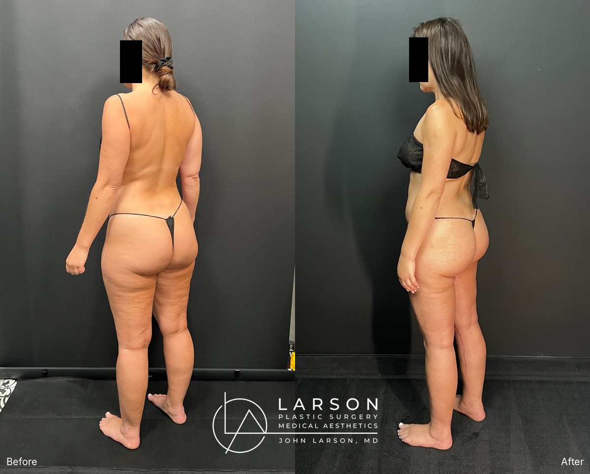“Before and after three-stage lipedema surgery in a 37-year-old woman, showing full-leg and hip liposuction with thigh and calf lifts, 3 months post-op, Newport Beach”